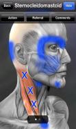 Trigger Points